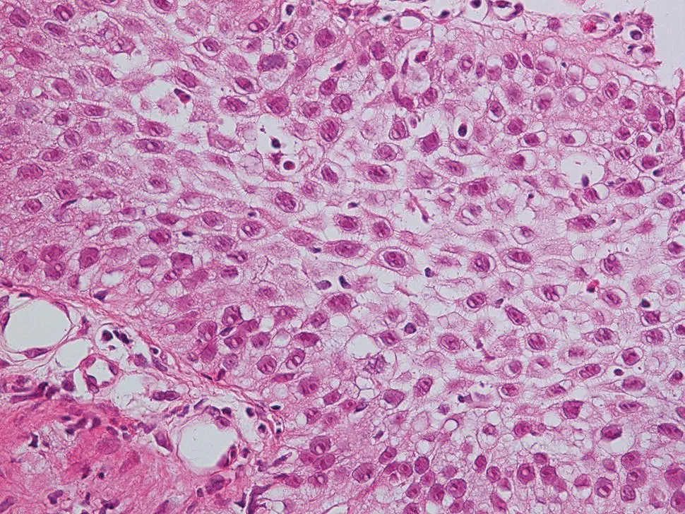 Figure 211 Highpower magnification of reflux esophagitis with basal cell - фото 28