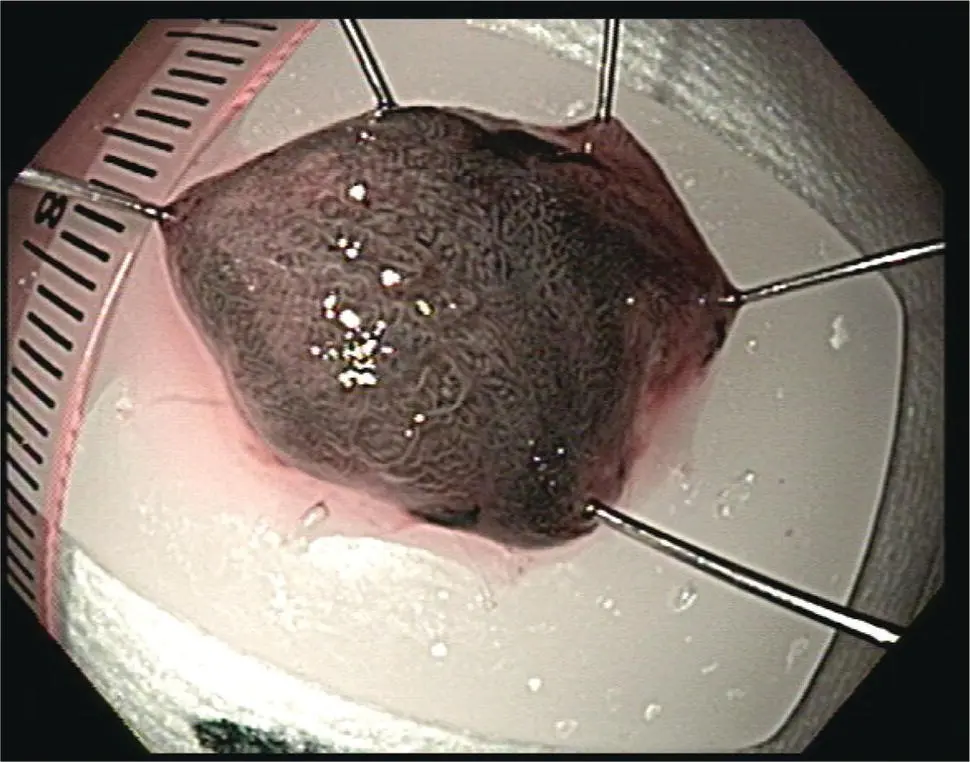Figure 110 Pinned and oriented resection tissue from Barretts - фото 11