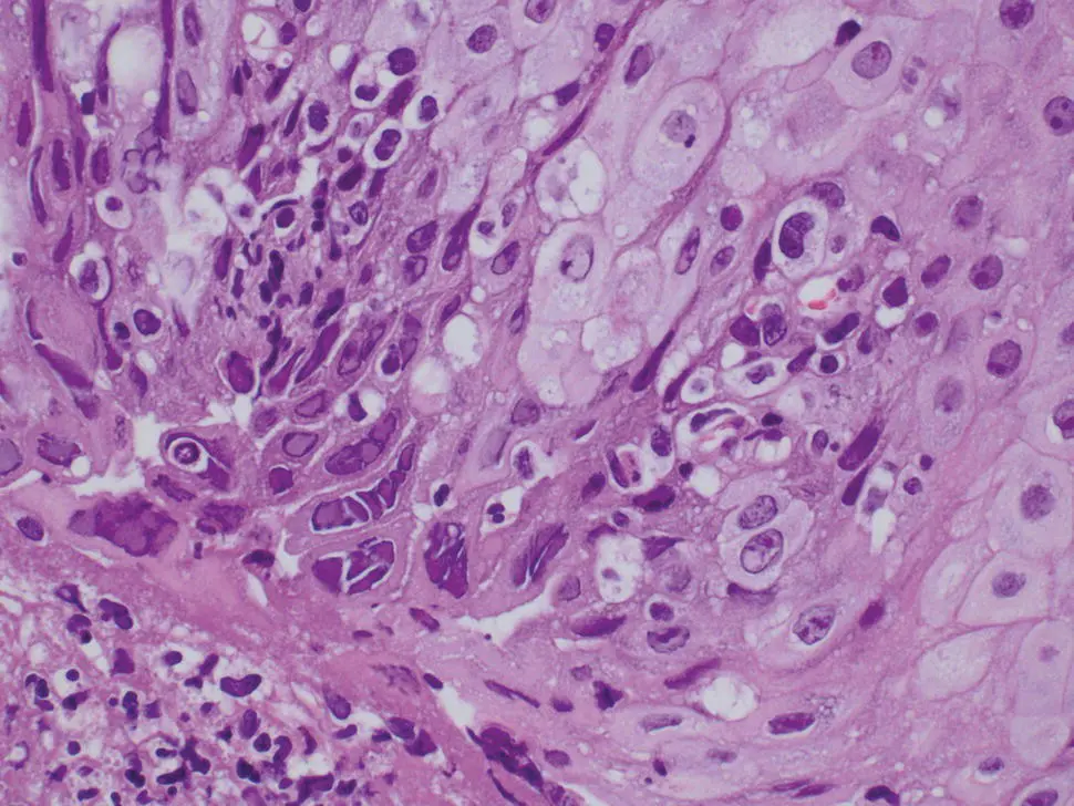 Figure 26 Multinucleated basal keratinocytes typical of HSV esophagitis - фото 23