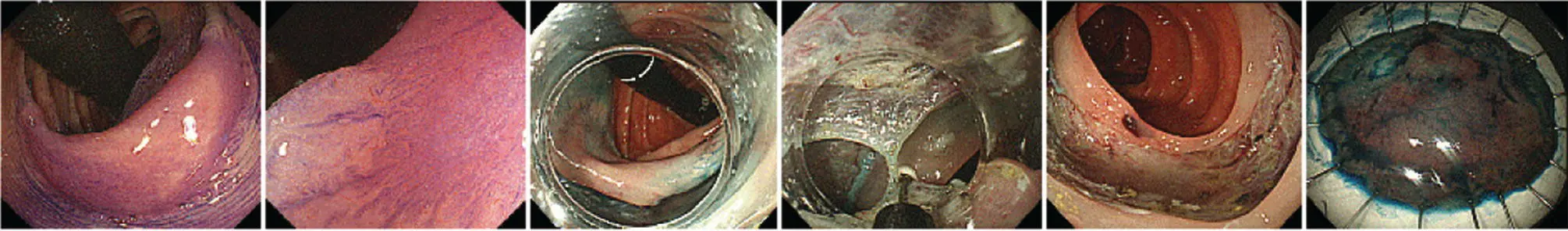 Figure 114 Endoscopic submucosal dissection ESD procedure A flat neoplastic - фото 15