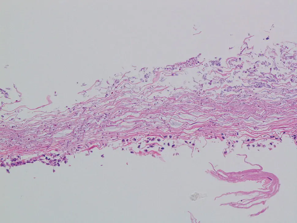 Figure 24 Debris of slough off superficial squamous epithelium with fungal - фото 21