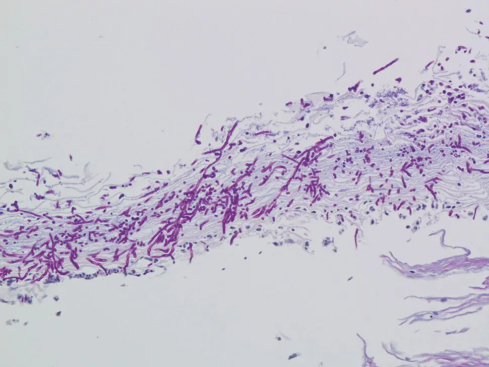 Figure 25 PAS stain of Figure 24illustrating the fungal elements of Candida - фото 22