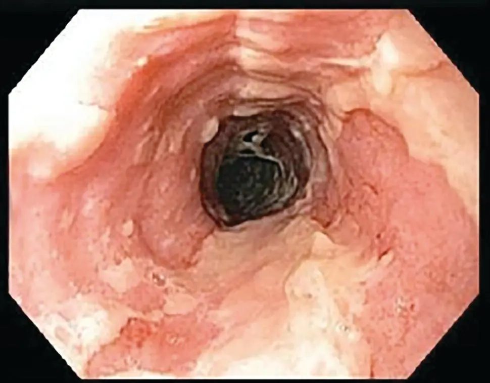Figure 219 Endoscopic appearance of acute GVHD of esophagus with diffuse - фото 36
