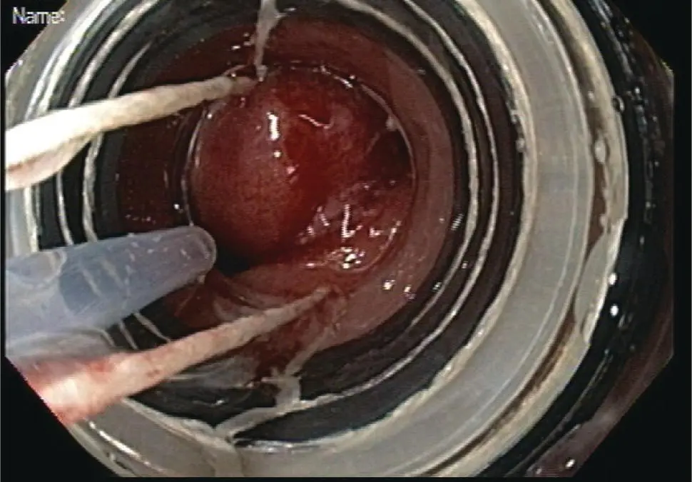 Figure 112Multiband mucosectomy device The black rubber bands are mounted on - фото 13