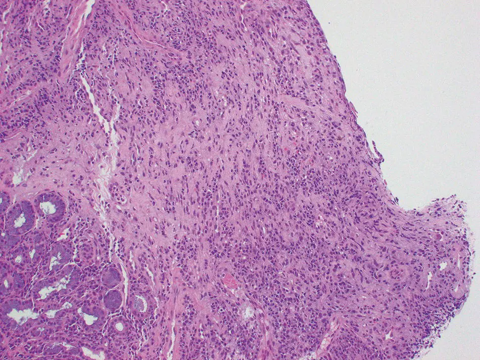 Figure 27 Erosive esophagitis with prominent granulation and atypical cellular - фото 24