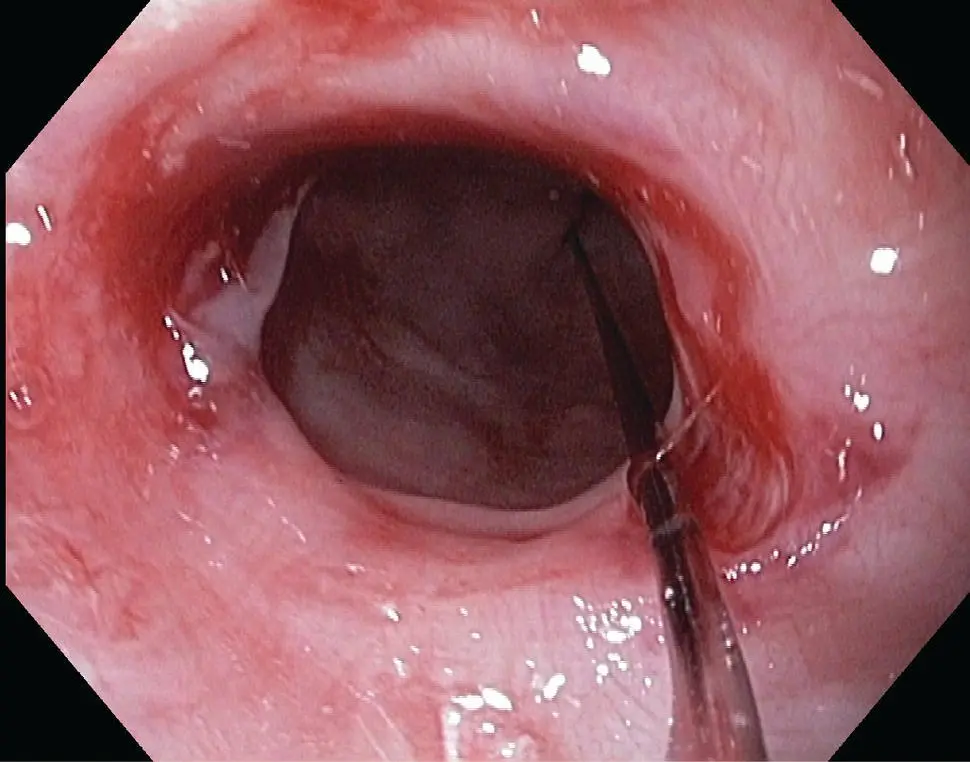 Figure 215 Endoscopic appearance of inflammatory stricture of the esophagus - фото 32