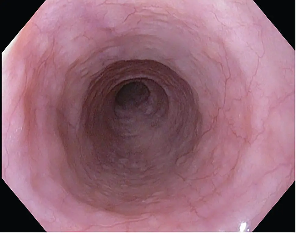 Figure 21 Endoscopic appearance of distal esophagus with normal squamous - фото 18
