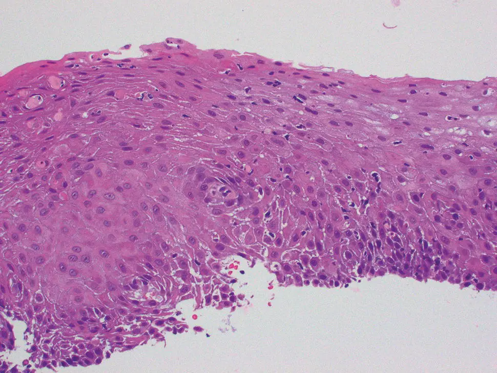 Figure 221 Microscopic appearance of acute GVHD of esophagus with basal - фото 38