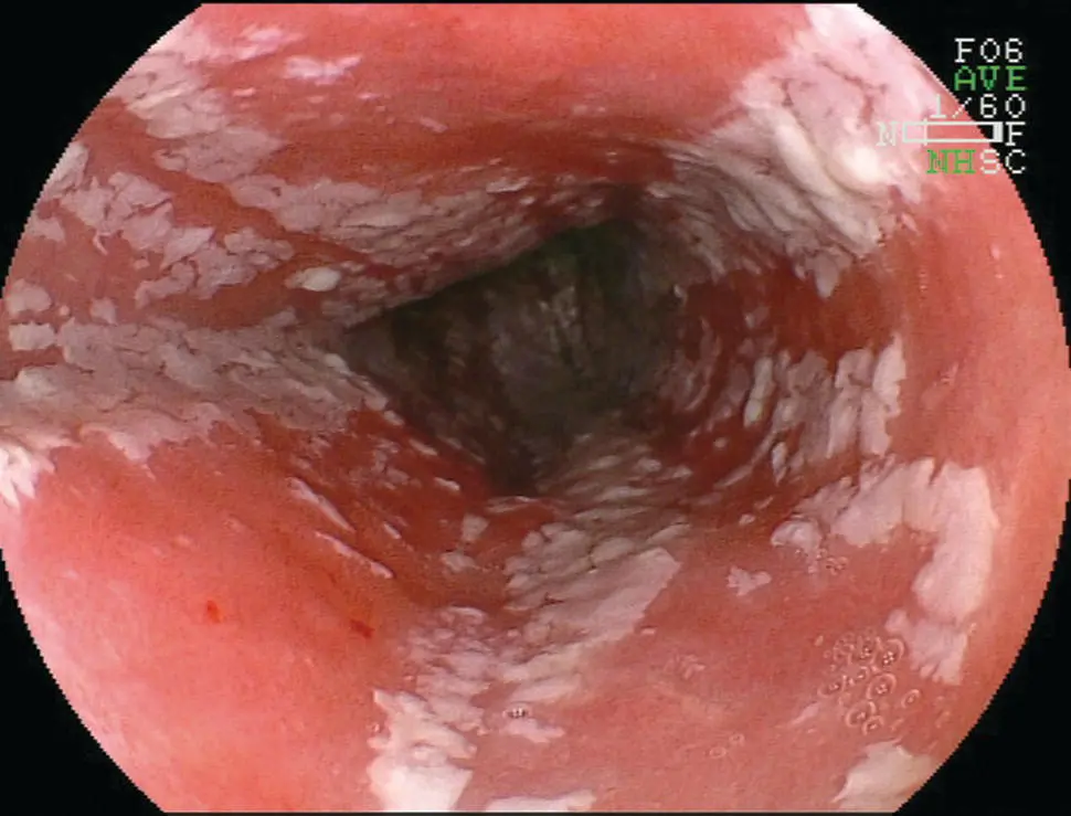 Figure 23 Endoscopic appearance of white exudate typical of Candida albicans - фото 20