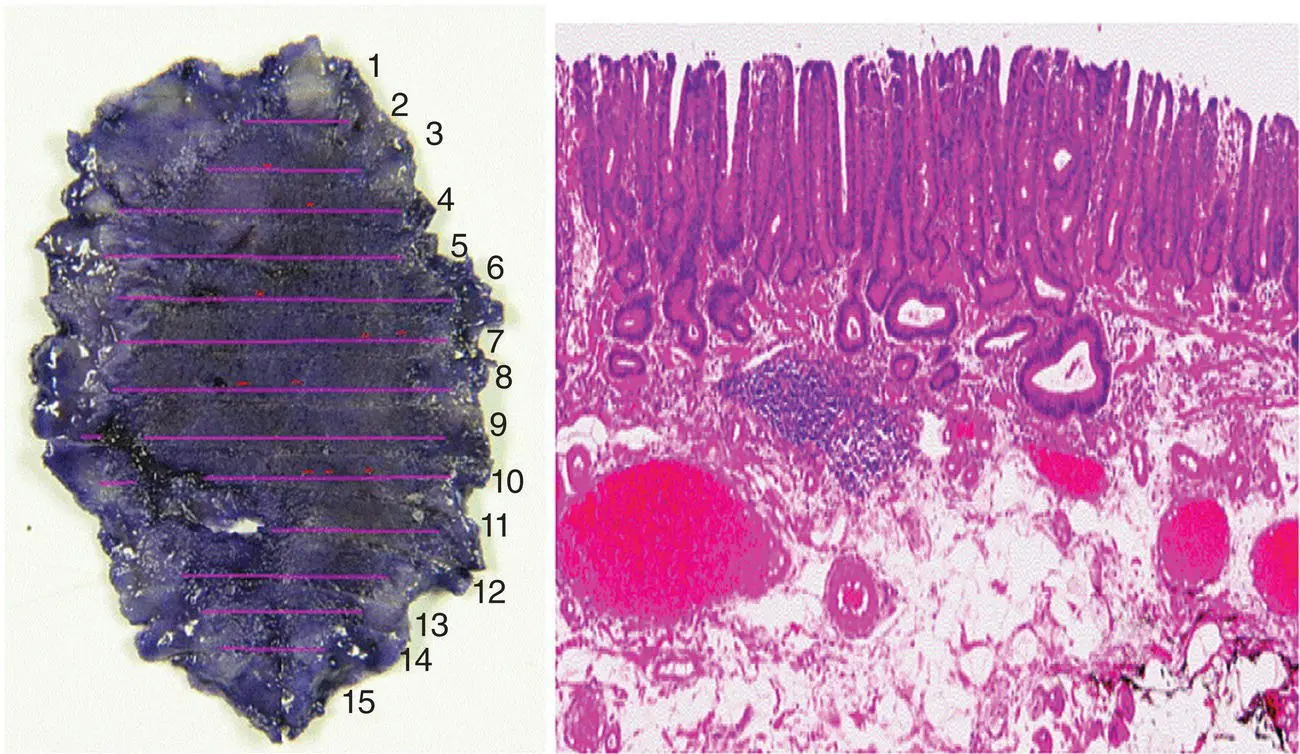 Figure 115 Endoscopically resected en bloc welldifferentiated adenocarcinoma - фото 16