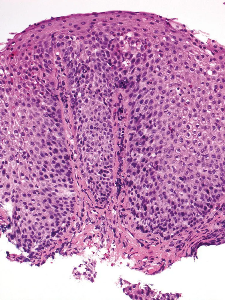 Figure 210 Characteristic appearance of lowpower view of reflux esophagitis - фото 27