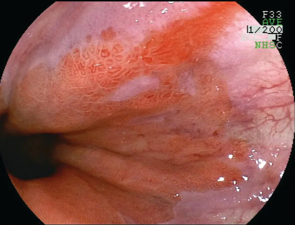 Figure 29 Endoscopic appearance of erosive esophagitis in a patient with - фото 26