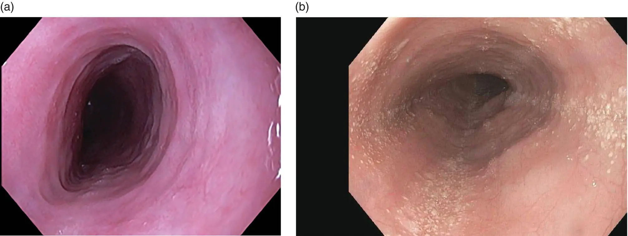 Figure 212 Endoscopic appearance of eosinophilic esophagitis a with - фото 29