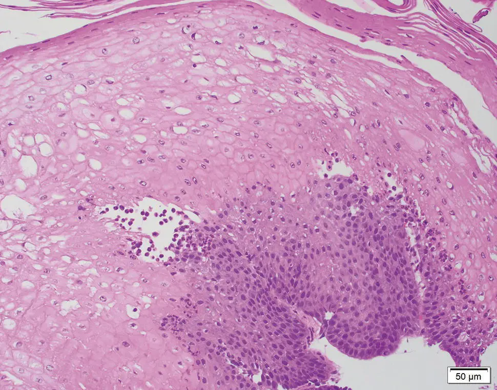 Figure 218 Characteristic appearance of sloughing esophagitis with twotone - фото 35