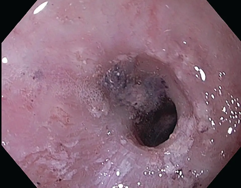 Figure 220 Endoscopic appearance of inflammatory stricture with persistent - фото 37