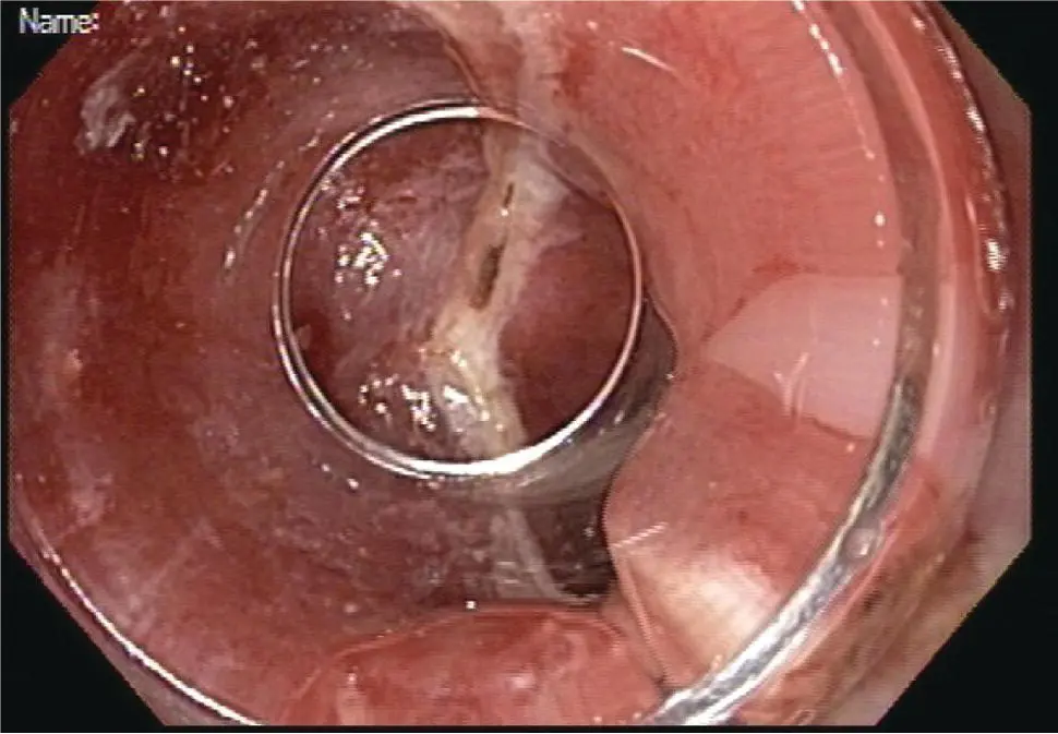 Figure 113 Area of resection at 612 oclock includes the entire region of - фото 14