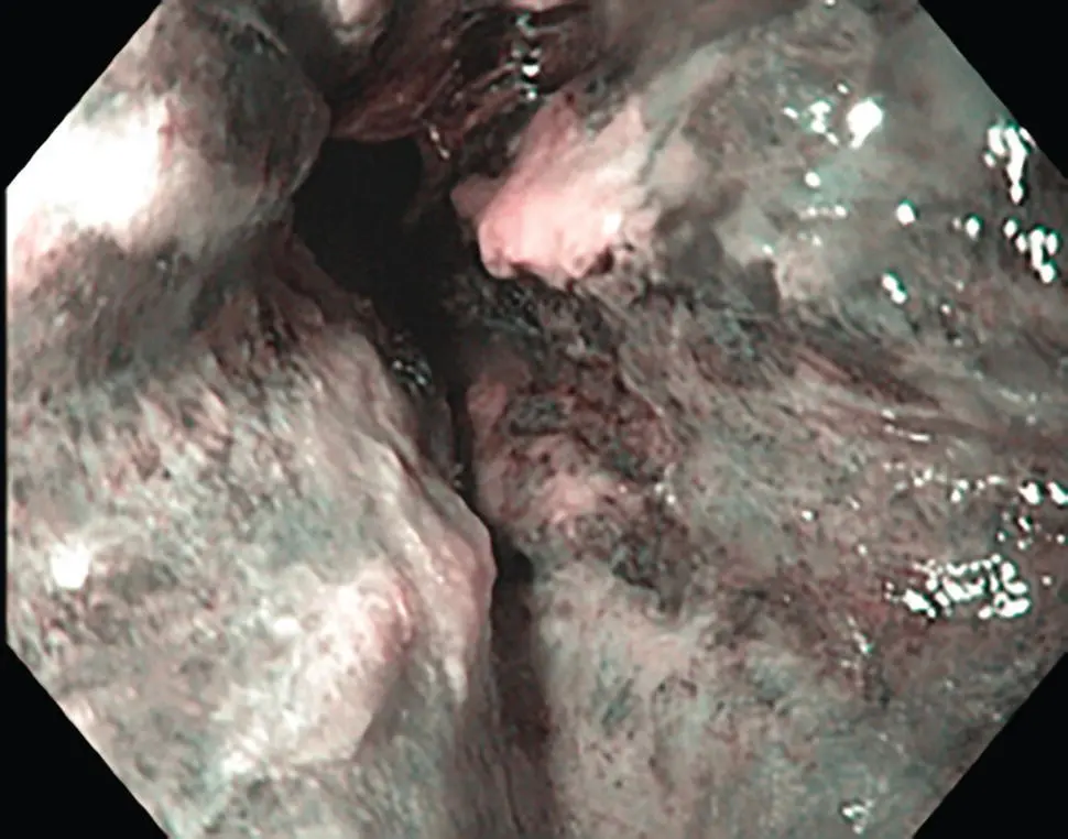 Figure 217 Endoscopic appearance of necrotizing esophagitis with appearance of - фото 34