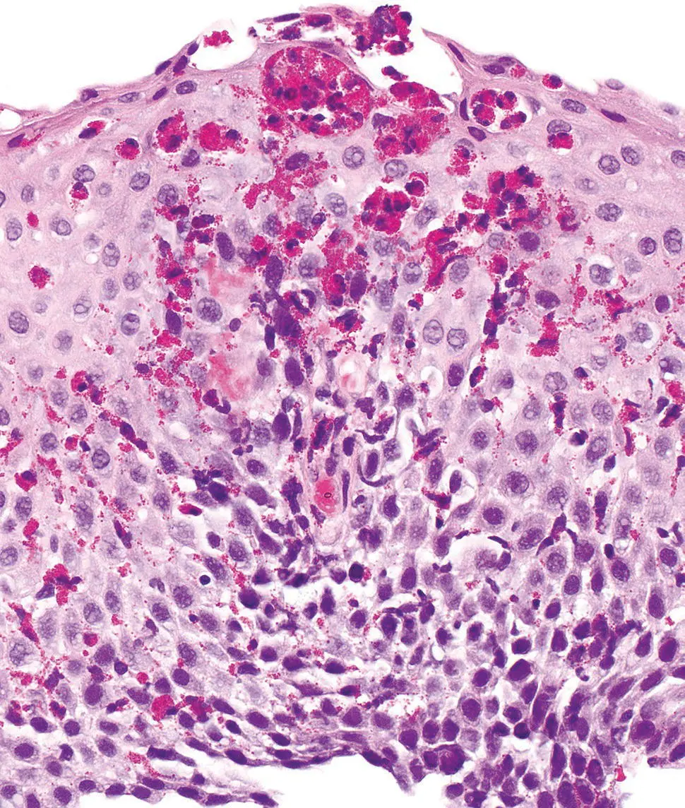 Figure 213 Characteristic histology of eosinophilic esophagitis with basal - фото 30