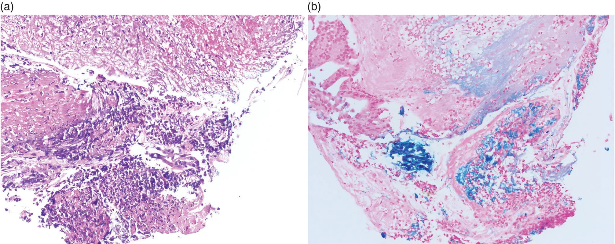 Figure 216 a Iron tablet erosive esophagitis with fibrinopurulent debris - фото 33