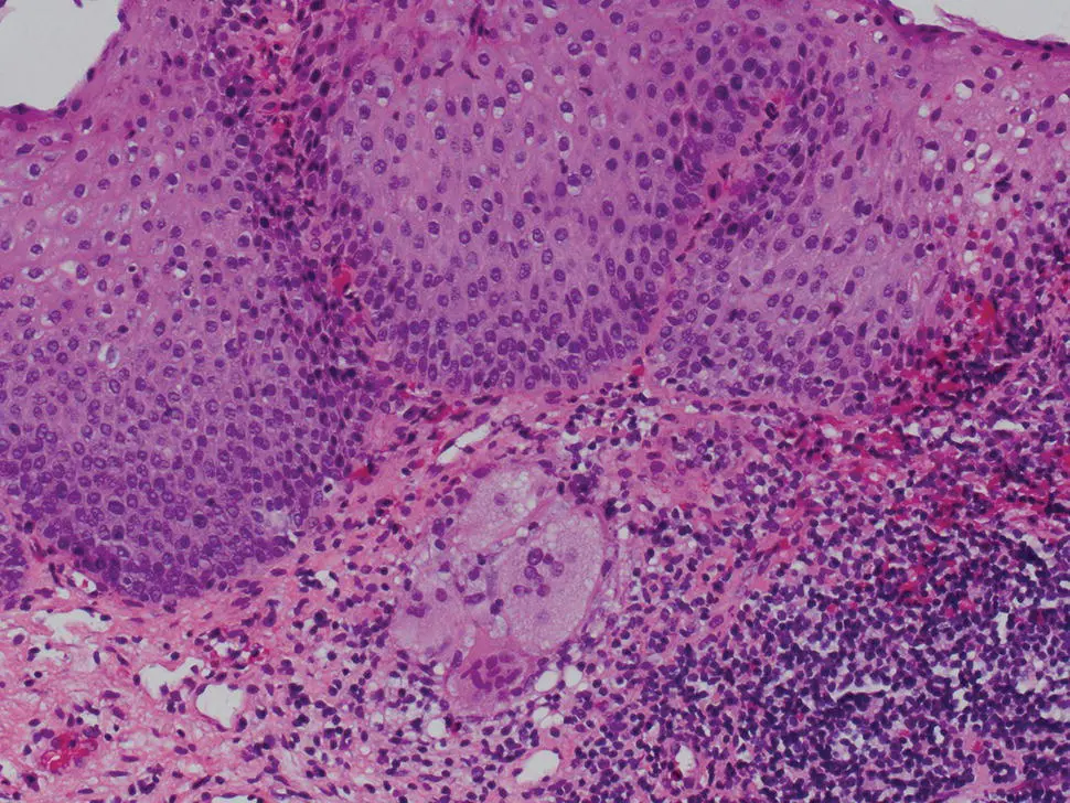Figure 223 Esophageal granuloma in a previously diagnosed patient with Crohns - фото 40