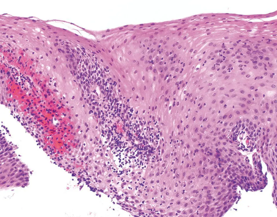 Figure 214 Characteristic histology of lymphocytic esophagitis Microscopic - фото 31