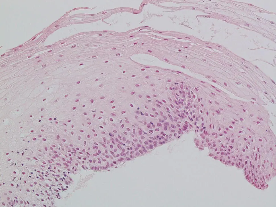 Figure 22 Normal esophagus squamous mucosa with normal stratified - фото 19