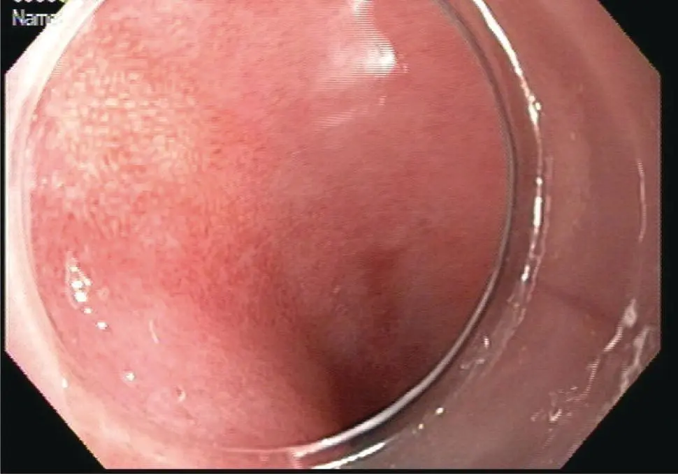 Figure 111 Barretts esophagus with flat neoplasia 9 oclock for targeted - фото 12