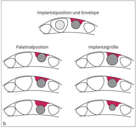 Abb 112a Für die Erfolgsaussichten einer lokalisierten Augmentation ist die - фото 25