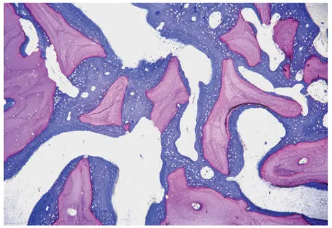 Abb 26Partikel von xenogenem Knochenersatzmaterial rosa werden im Rahmen - фото 37