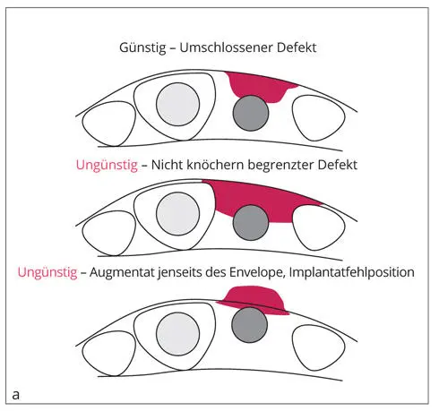 Abb 112a Für die Erfolgsaussichten einer lokalisierten Augmentation ist die - фото 24