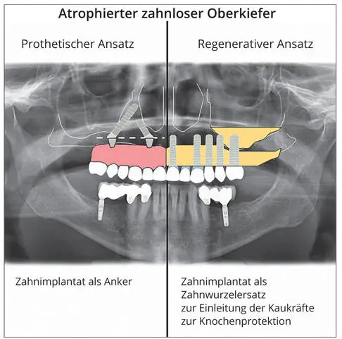 Abb 113Defektprothetik versus Regeneration Beim defektprothetischen Ansatz - фото 26