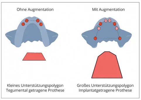 Abb 14Bei der implantatprothetischen Versorgung des Oberkiefers kann man die - фото 7