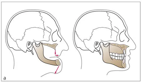 Abb 19Effekte der Augmentation bei Alveolarkammatrophie a - фото 19