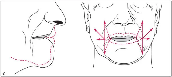 Abb 19Effekte der Augmentation bei Alveolarkammatrophie a Die - фото 21