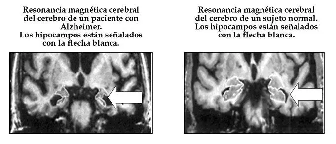 En la enfermedad de Alzheimer se atrofian de manera predominante los hipocampos - фото 4