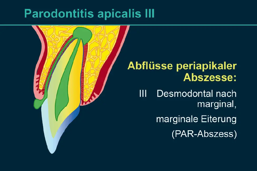 Abb 5 Parodontitis periapicalis mit desmodontaler Fistelung nach marginal - фото 63