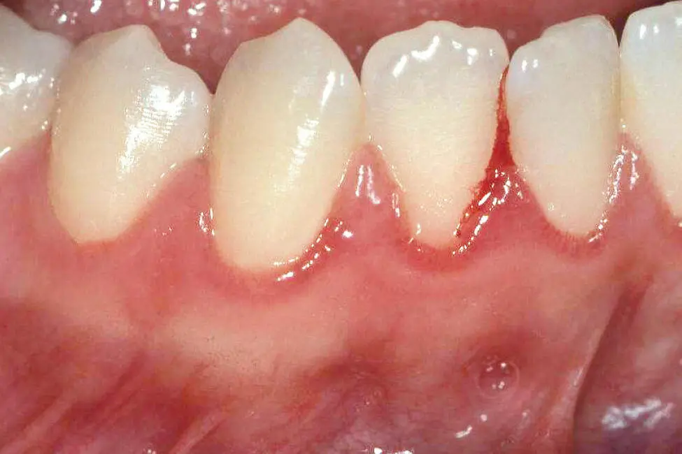 Abb 7 Klinisch manifeste plaqueinduzierte Gingivitis interdental oraler - фото 25