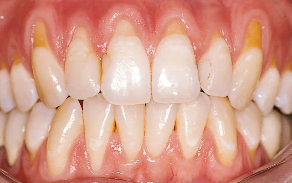 Abb 3 Patientin mit generalisierten gingivalen Rezessionen RT1 im Ober und - фото 74