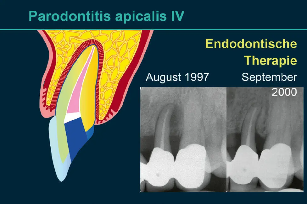 Abb 10 Der endodontal verursachte Entzündungsprozess zerstört die Verbindung - фото 71