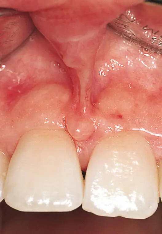 Abb 5 Interdental der Zähne 11 und 21 marginal einstrahlendes - фото 76