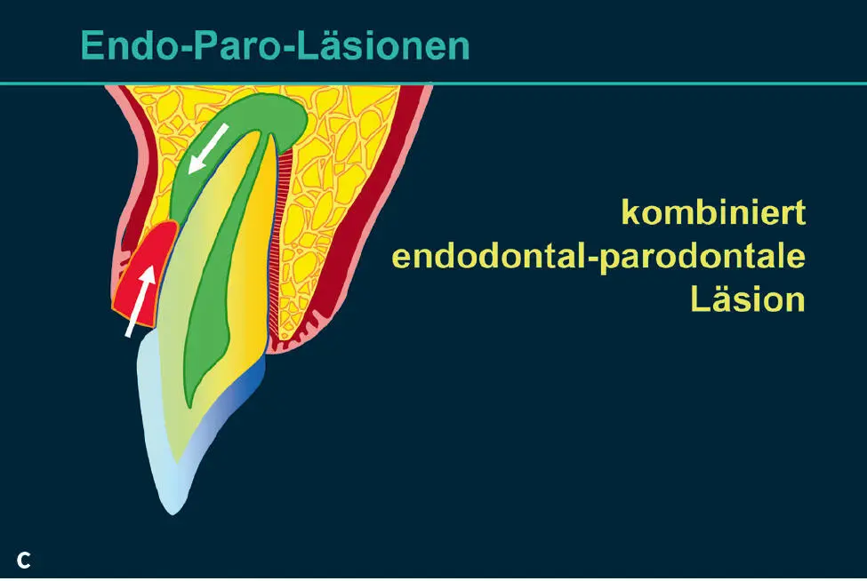Abb 2 Endodontalparodontale Läsionen a primär endodontale Läsion b primär - фото 60
