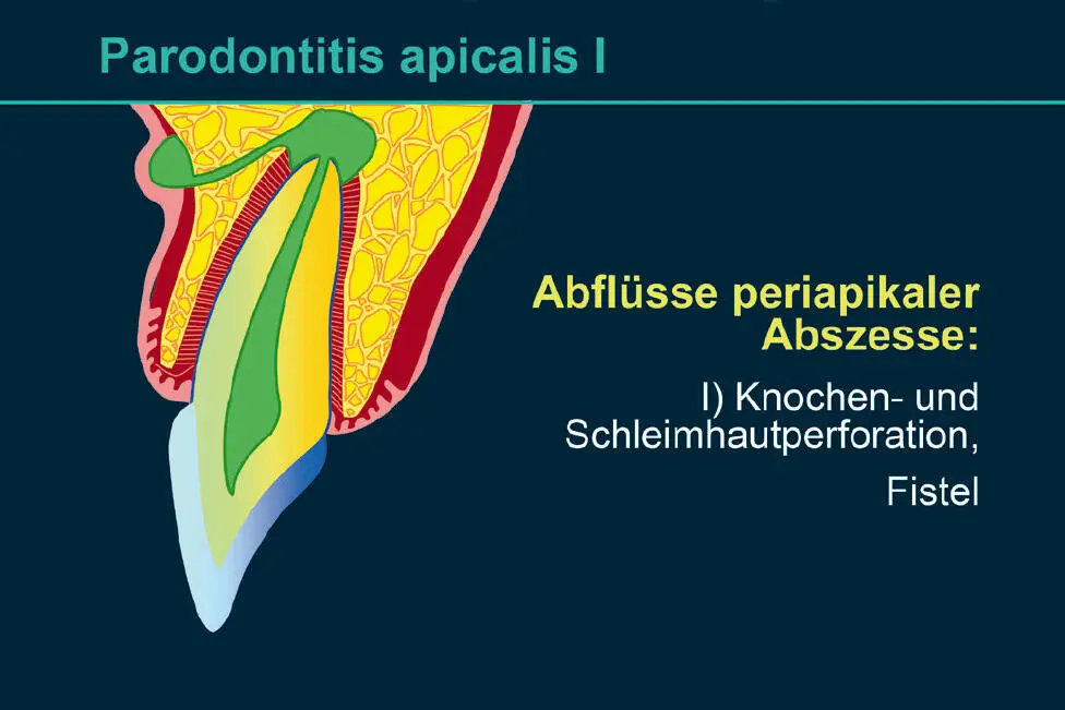 Abb 3 Parodontitis periapicalis mit Fistelung nach vestibulär Abb 4 - фото 61