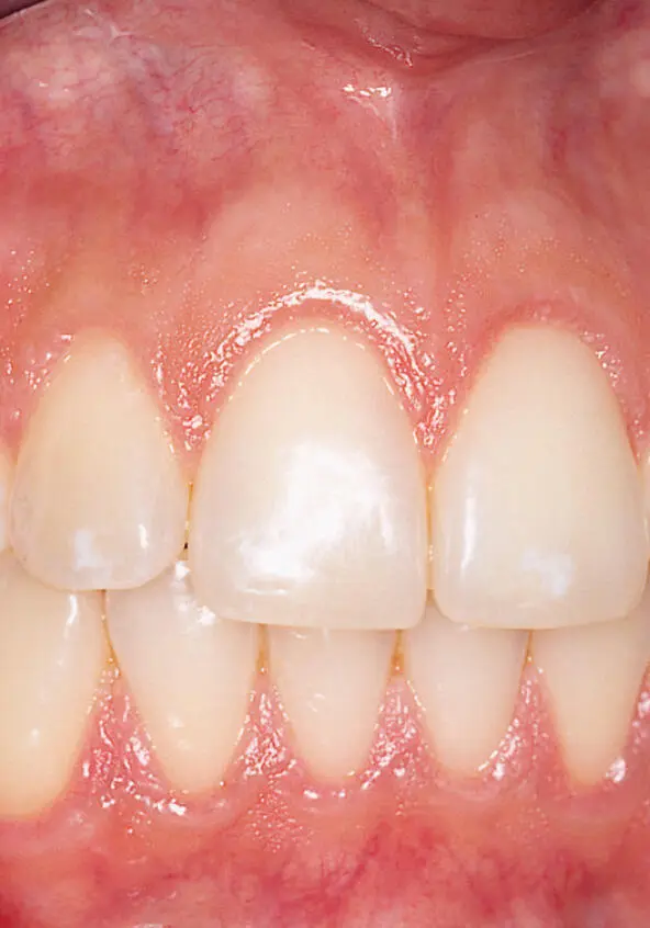 Abb 1 Klinisch entzündungsfreie Gingiva einer 26jährigen Frau Es liegen - фото 72