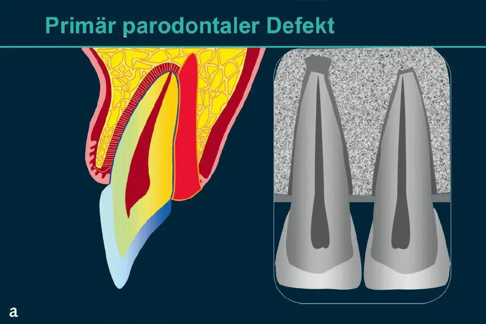 Abb 9 Palatinaler Knochendefekt primär parodontalen Urspru - фото 68