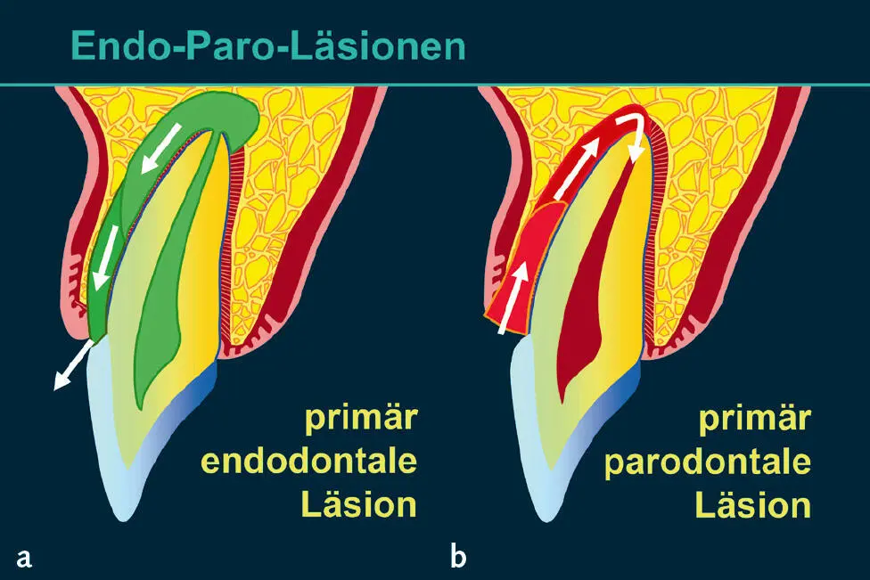 Abb 2 Endodontalparodontale Läsionen a primär endodontale Läsion b primär - фото 59