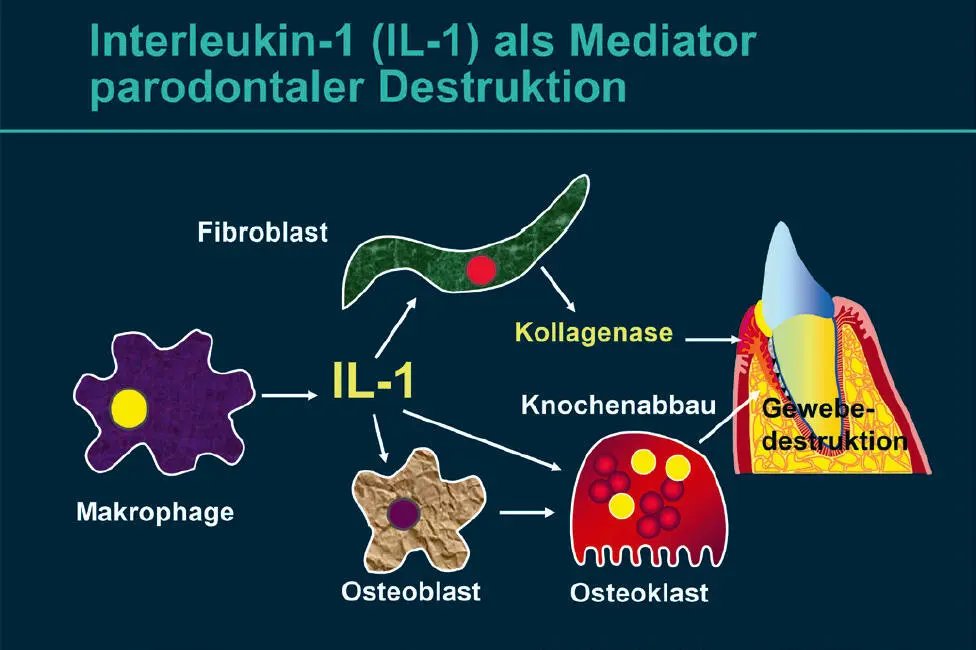 Abb 6 Interleukin1β IL1β als Mediator parodontaler Destruktion IL1 wird - фото 24