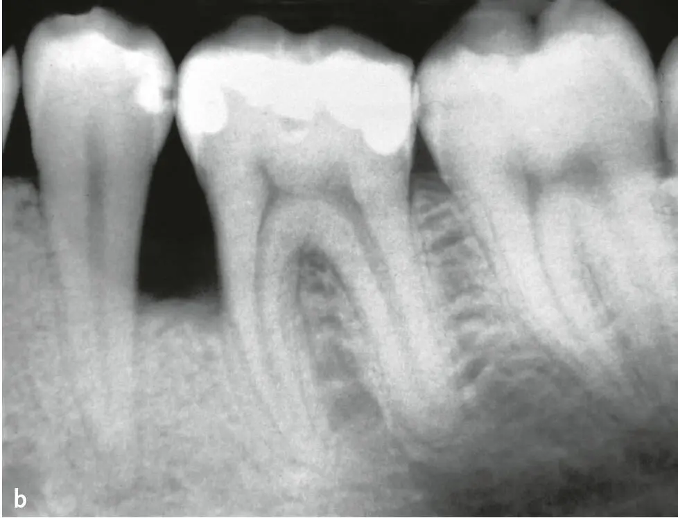 Abb 3a und b 24jähriger männlicher Patient mit oralen Manifestationen einer - фото 57