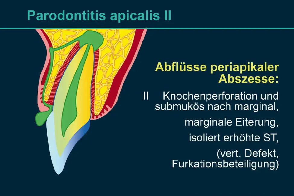 Abb 4 Parodontitis periapicalis mit submuköser Fistelung nach marginal - фото 62