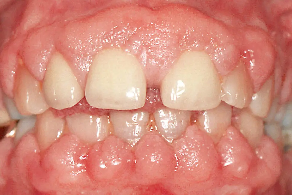 Abb 4 Phenytoininduzierte Gingivawucherung Kalziumkanalblockerantagonisten - фото 43