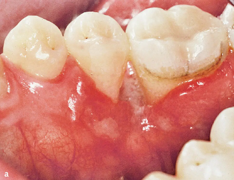Abb 3a und b 24jähriger männlicher Patient mit oralen Manifestationen einer - фото 56